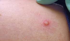 Secretaria Municipal de Saúde faz alerta sobre a varíola símia (varíola de macados). Já existem casos da doença na região.