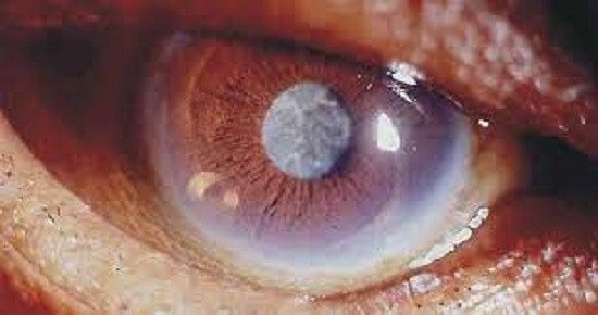 Cirúrgia de Catarata: 24 pessoas serão atendidas em agosto. 14 já passaram pela operação