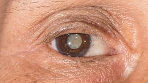 Nova visão: Ao longo de 3 anos, Secretaria de Saúde realizou 465 cirurgias de catarata reduzindo sobremaneira a fila